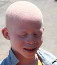 Albinism - Wikipedia, the free encyclopedia