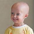 Genetic Disorder Research - Hutchinson-Gilford PROGERIA Syndrome