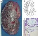 <b>Kidney</b> tumor - cysts, children