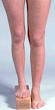 Limb <b>length discrepancy</b> can be