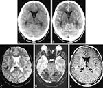 <b>meningoencephalitis</b>.