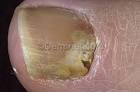 Subungual <b>Onychomycosis</b>
