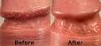 Pearly Penile Papules - Treat and Remove Your Penile Bumps