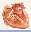 Cardiac <b>catheter ablation</b>
