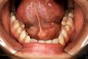 of a <b>salivary gland</b> duct.