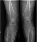 Hereditary multiple <b>exostoses</b>