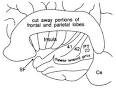 <b>CENTRAL HEARING LOSS</b>