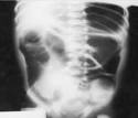 sin <b>perforación intestinal</b>