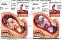 Fetal <b>Chorioamnionitis</b>, Sepsis and Fetal Distress - Medical