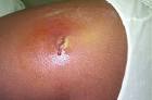 <b>Infections</b> of the Skin and its