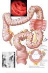 DIVERTICULITIS Medical, Health & Disease Pictures & Images