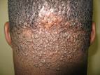 Diffuse Follicular <b>Keloids</b>