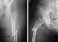de <b>fracturas</b> de <b>fémur</b>.