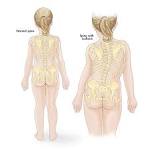 Idiopathic <b>scoliosis</b> does tend