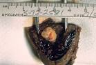 File:<b>Tubal pregnancy</b>, gross