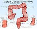 Colon cancer (colorectal