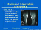Diagnosis of <b>Osteomyelitis</b>: