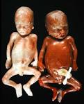 <b>Transfusión feto</b>-<b>fetal</b> en RNP