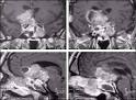 local <b>tumor</b> complications,