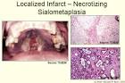 <b>Sialometaplasia</b>