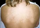<b>Tinea versicolor</b> is a common