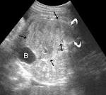 <b>Mesoblastic nephroma</b>.