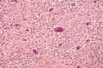 File:<b>Osteosarcoma</b>.jpg