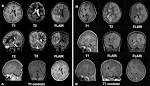 <b>encephalitis</b>.png