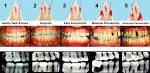 Stages of <b>Periodontal Disease</b>
