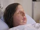 Woman mauled by chimp shows post-transplant face in photo | News ...