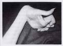 Hand Dystonia in Wilson's