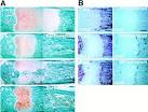 <b>Takykardi</b>, <b>ektopisk atriell</b> www.lookfordiagnosis.com