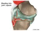 Anterior Cruciate Ligament Injuries | eorthopod.