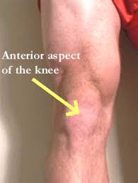 Knee Pain Troubleshooting Images?q=tbn:ANd9GcRQHSijhgqvwufHn75EsAUgERuiEDuUO8lWE7fjjPFsG3zhWpIW