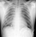 Chest Radiology