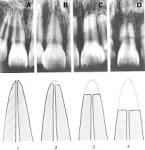 of <b>root resorption</b>.