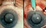 <b>Cataract Extraction</b>