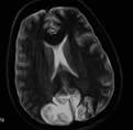 <b>Hypertensive Encephalopathy</b>