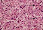 Metastatic Renal Cell Carcinoma1