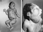 Definition of «<b>Microcephaly</b>»