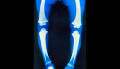 <b>Rickets</b> is usually caused by a