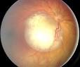 A <b>retinoblastoma</b> tumor grows
