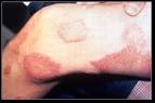 Extreme cases of leprosy,