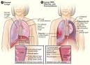 <b>Pleurisy</b> and Pneumothorax