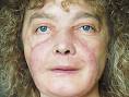 Woman undergoes FACE TRANSPLANT in Cleveland « Xenophilia (True ...