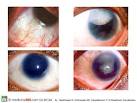<b>Nistagmo</b> oculare: tipologie