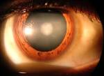File:<b>Cataract</b> in human eye.png