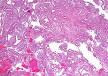 <b>Endometrial hyperplasia</b> - Wikipedia, the free encyclopedia