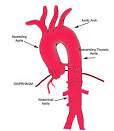An aortic aneurysm is an