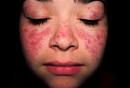 Picture of Systemic <b>Lupus</b>